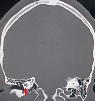 Cochlea in coronal CT