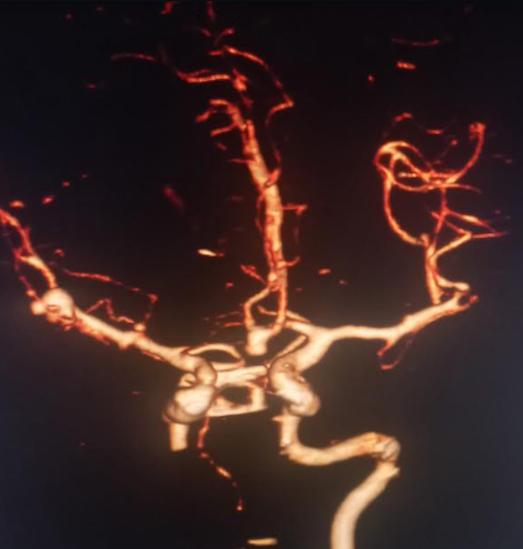 <p>Multiple Intracranial Aneurysms. Anterior communicating and right middle cerebral artery bifurcation.</p>