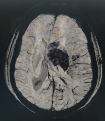 Hemorrhagic transformation within the left MCA territory infarction seen on SWI MRI sequence