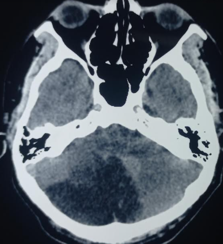 <p>CT Image of an Acute Cerebellar Infarction.</p>