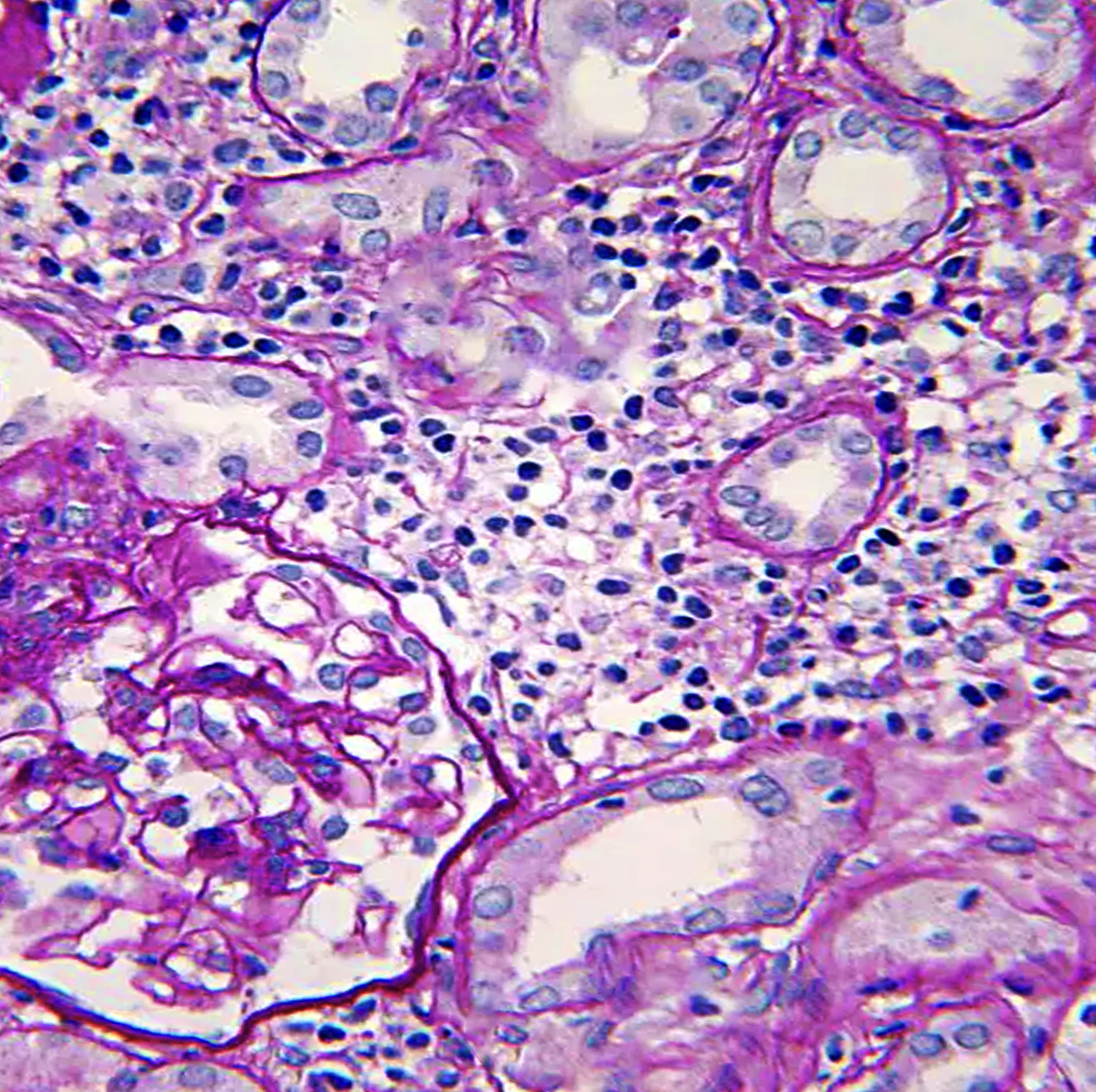 Kidney biopsy showing inflammatory infiltrate indicative of tubulointerstitial nephritis.