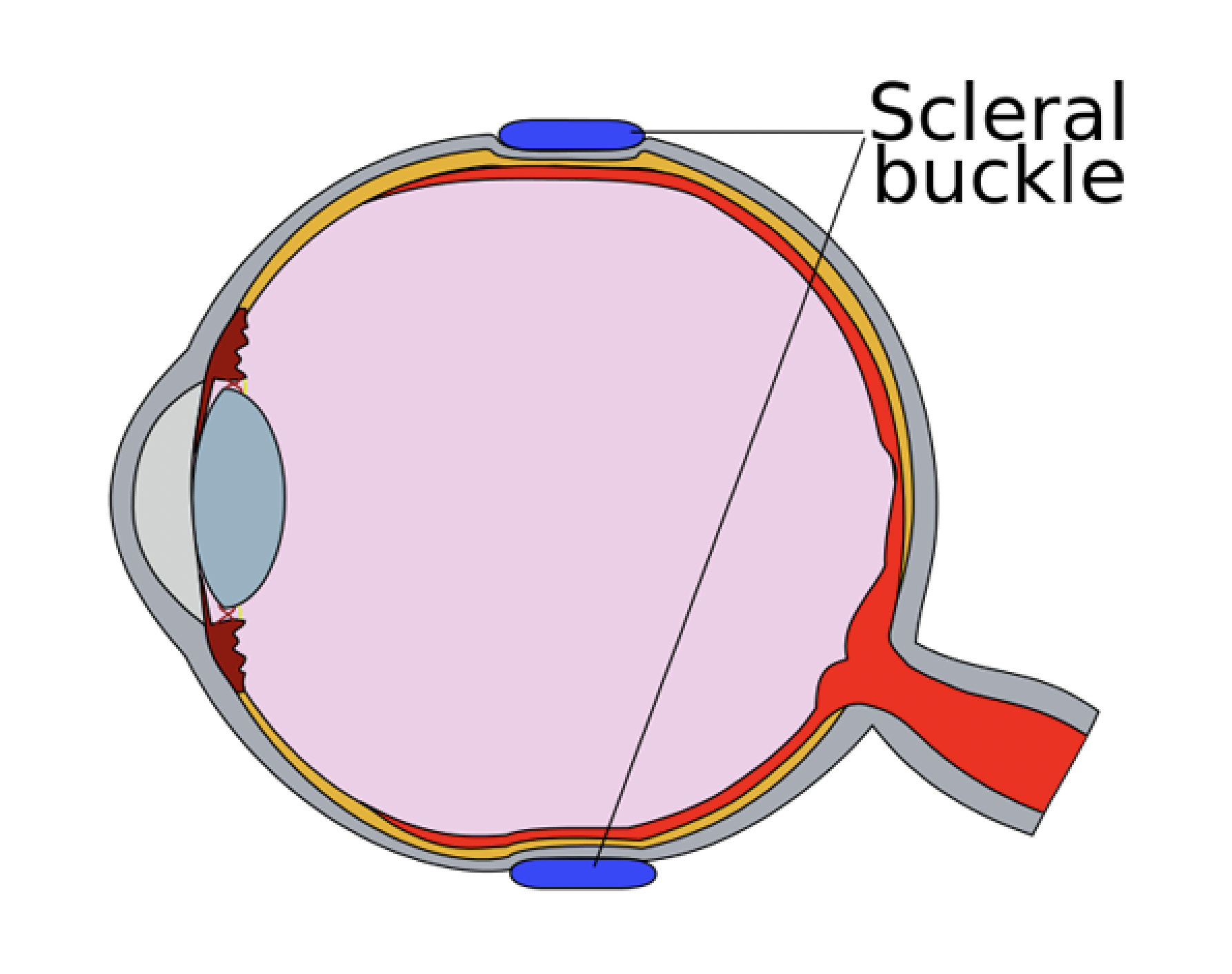 Diagram of scleral buckle.