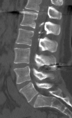 <p>Arachnoiditis Ossificans. This image shows calcification in the posterior L1 to L2 intraspinal region.</p>
