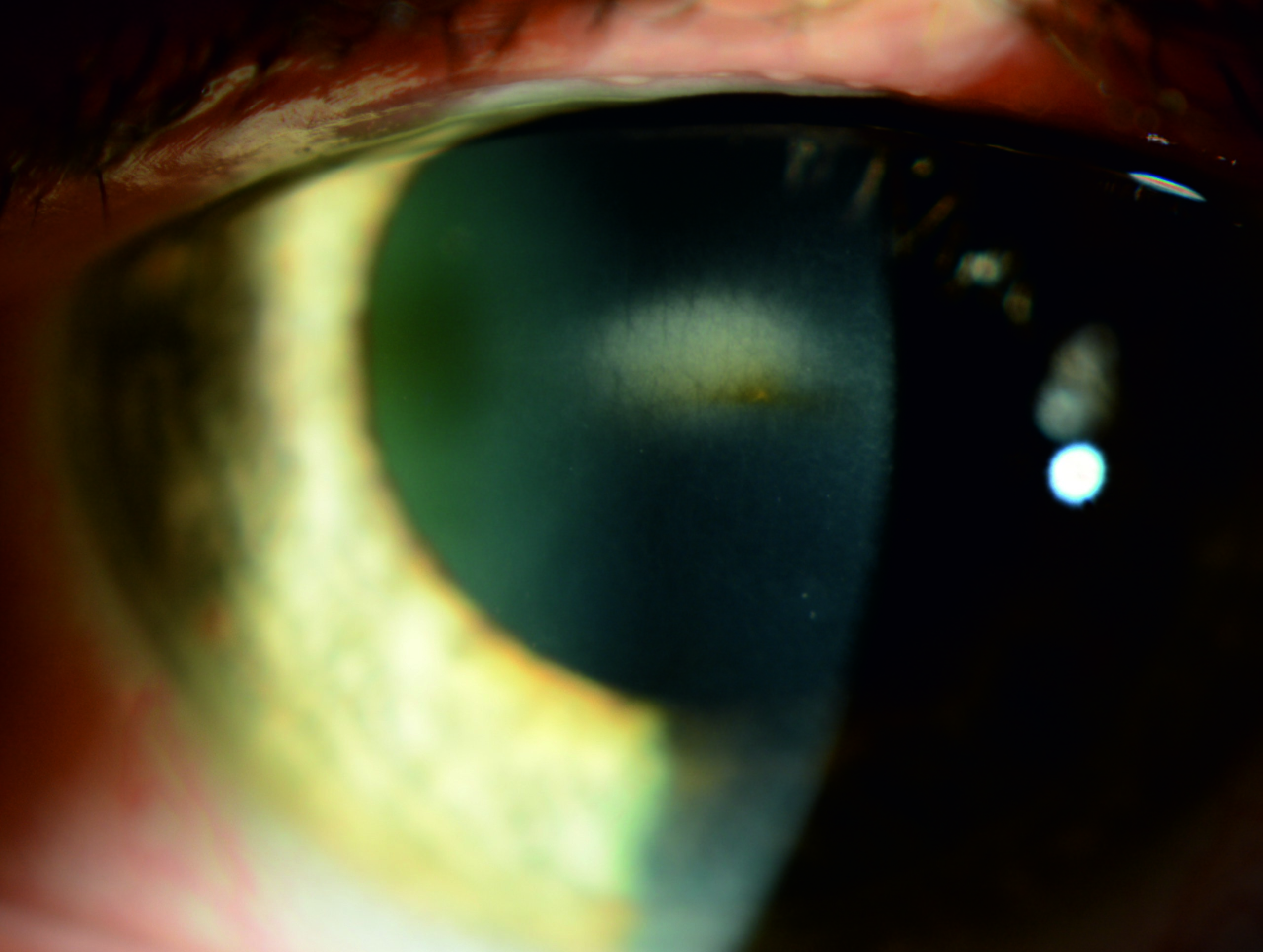 Example of corneal opacity in keratoendotheliitis fugax hereditaria.