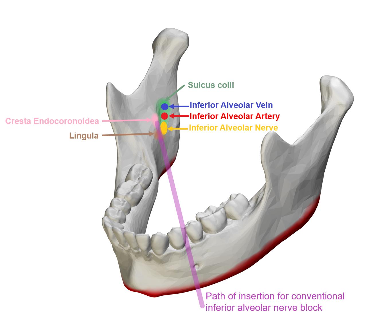 <p>Conventional Inferior Alveolar Nerve Block</p>