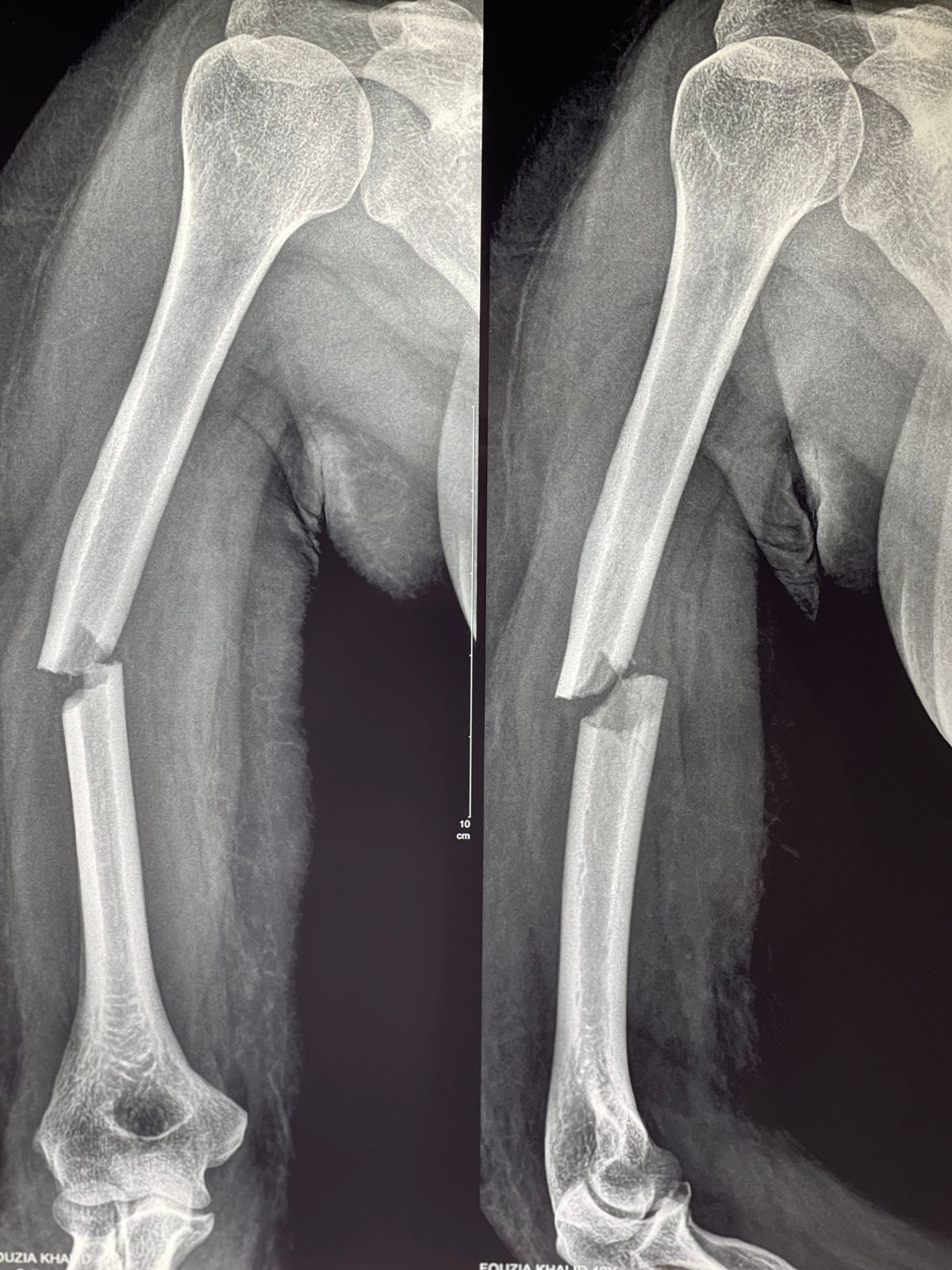 <p>Oblique Humeral Shaft Fracture. This radiograph shows an oblique, displaced middle-third humeral fracture.</p>