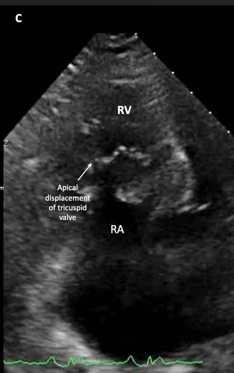 Apical displacement of tricuspid valve >8mm/m2 with enlarged right atrium, "atrialized" right ventricule and small "functional" right ventricle