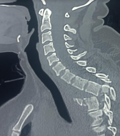 <p>Traumatic Thoracic Spondyloptosis on MRI