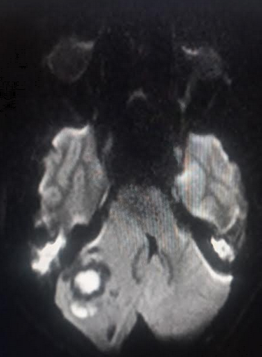 <p>Cerebellar Abscess. "Light bulb" sign in cerebellar abscess&nbsp;seen on DWI MR image.</p>