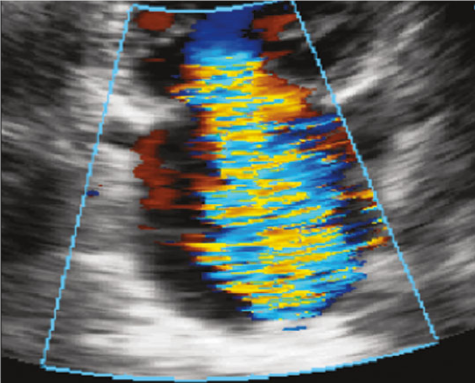 <p>&nbsp;Mitral Valve, Echocardiograph.&nbsp;A color Doppler echocardiogaph demonstrating the mitral valve.</p>