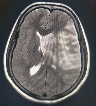 Subfalcine herniation in left MCA infarction where both distal anterior cerebral  arteries (DACA) are lying in vertical plane
