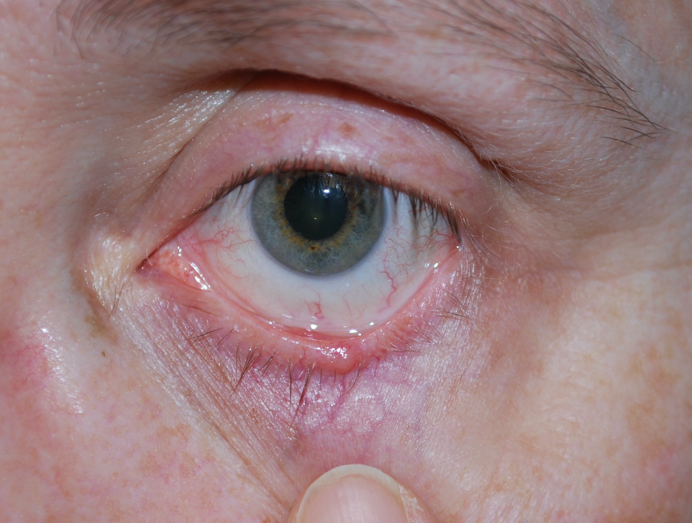 Basal Cell Carcinoma of the left lower eyelid