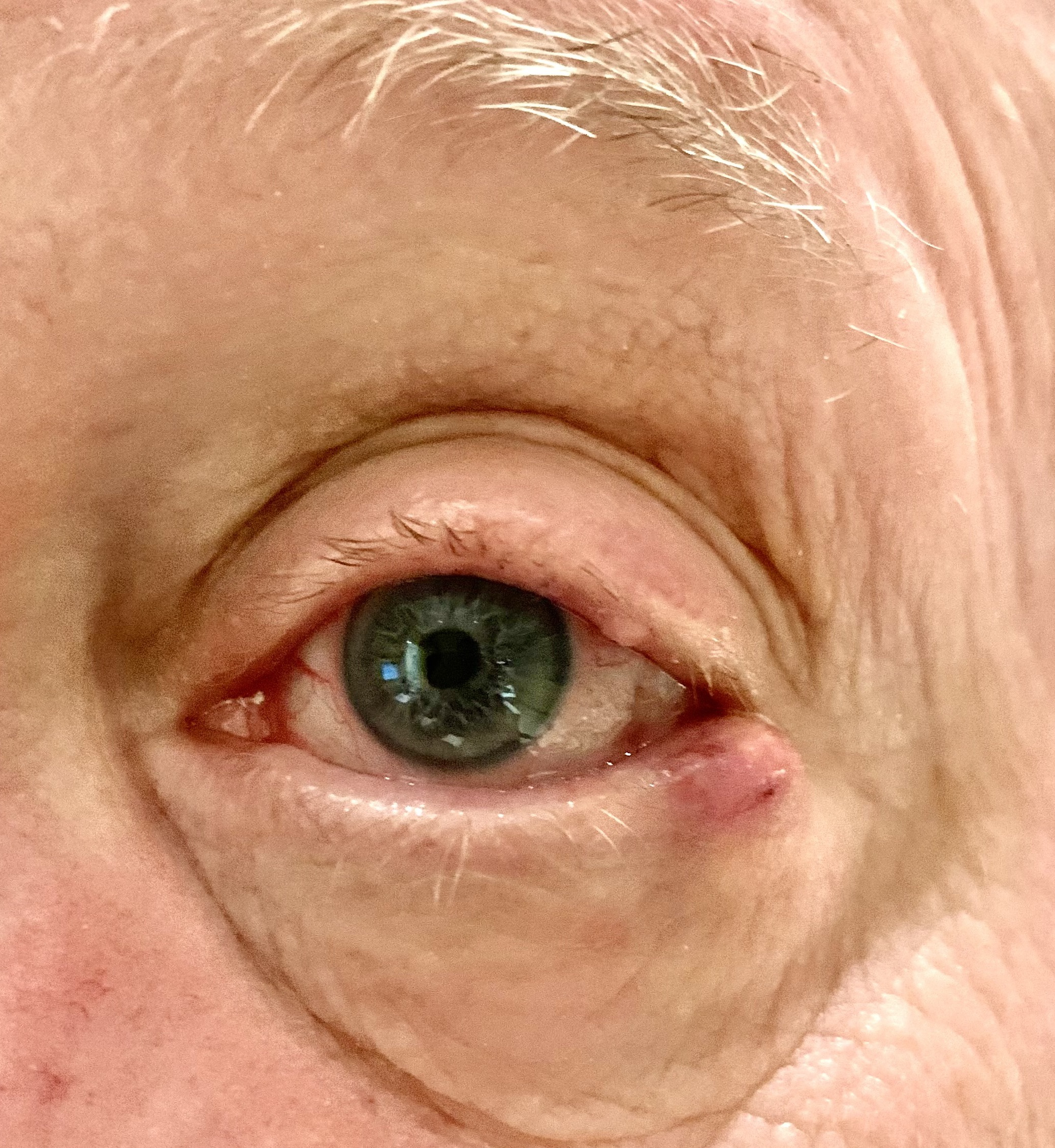Sebaceous Carcinoma of the lateral left lower eyelid