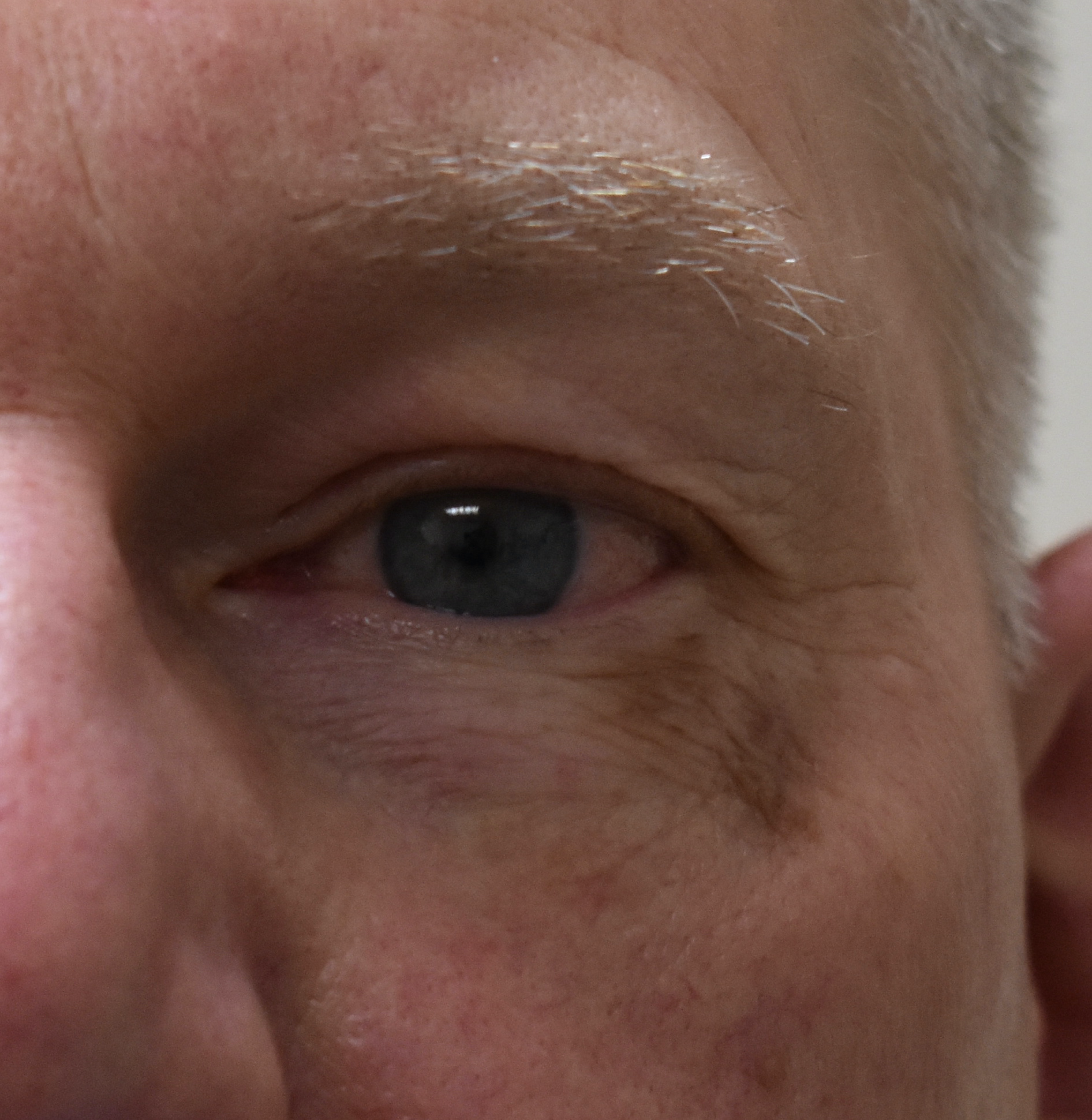 Melanoma in situ involving the left lower eyelid