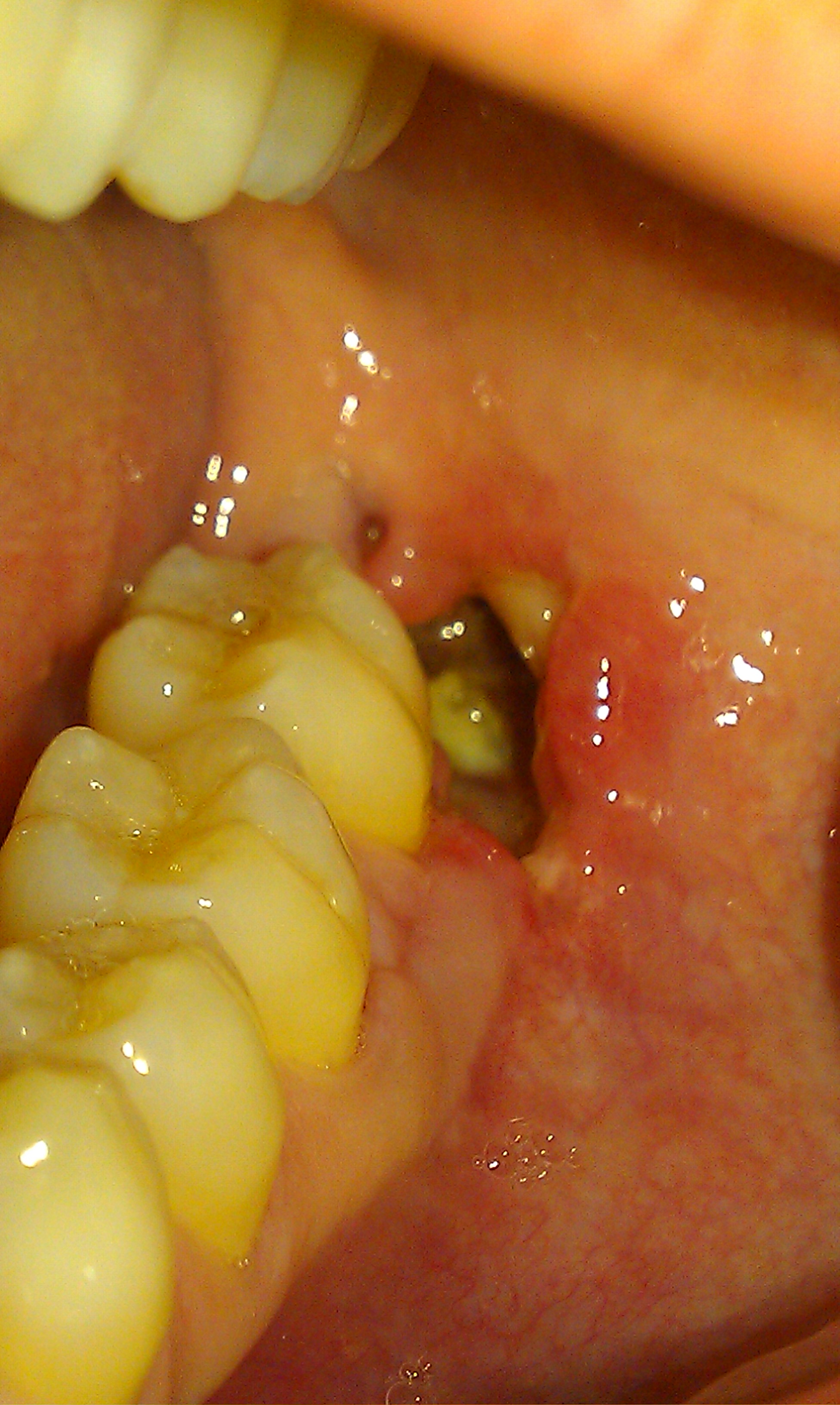 Alveolar osteitis (dry socket) after mandibular wisdom tooth extraction.