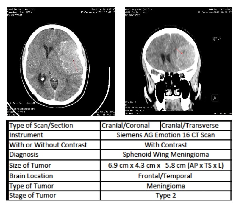 Computerized tomography scans of a frontal-temporal meningioma in a 30-year-old black female patient with Foster Kennedy syndrome (FKS)