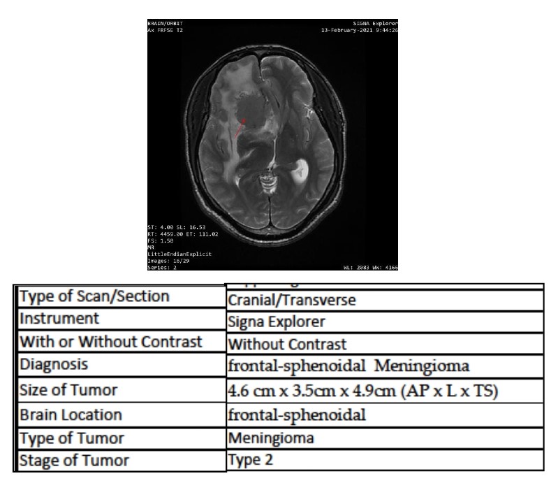 Computerized tomography scans of frontal-sphenoidal meningioma in 52-year-old black male patient with Foster Kennedy syndrome (FKS)