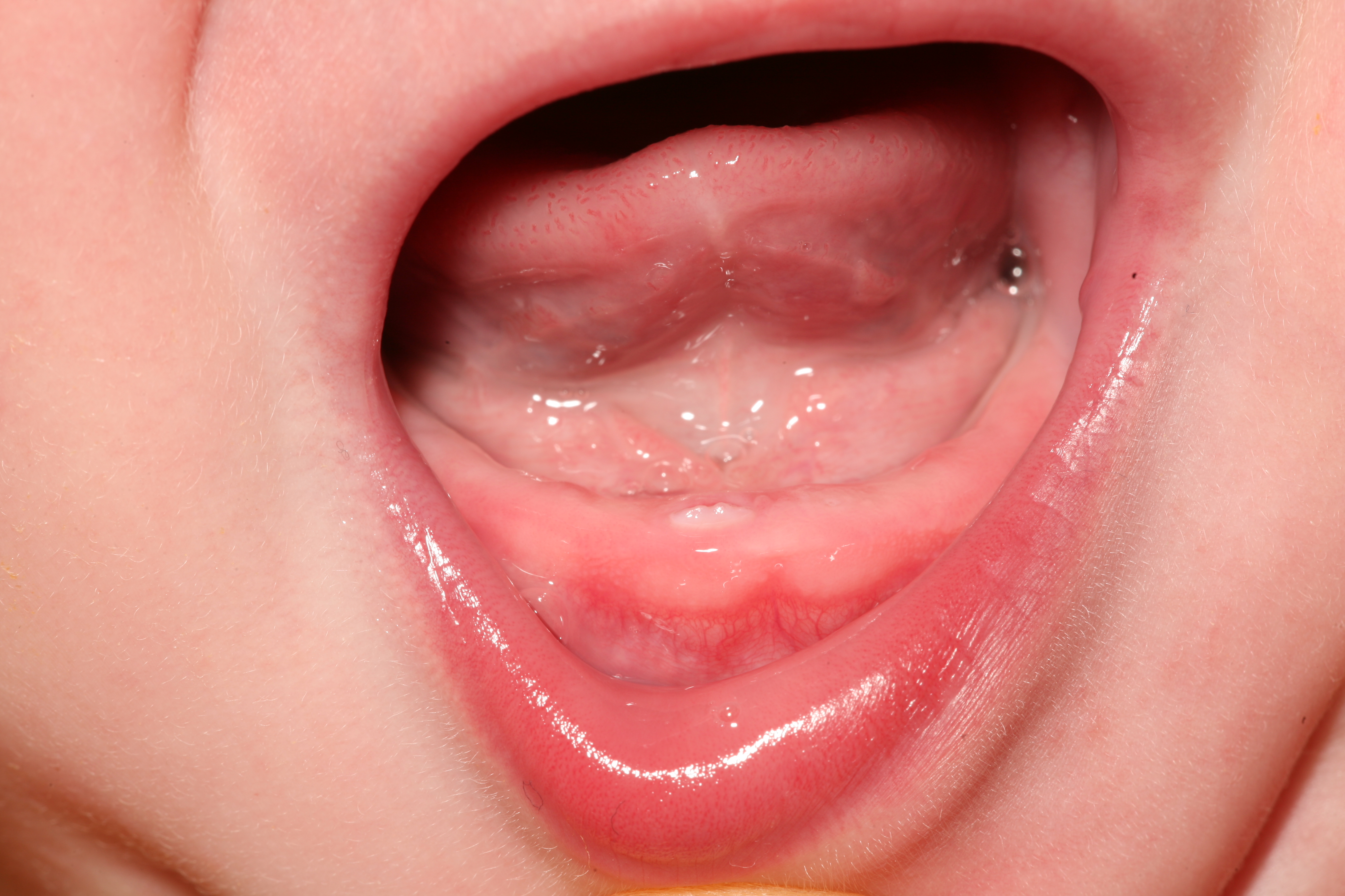 <p>Penetrating Incisor. The lower right incisor is shown penetrating the oral mucosa of a teething baby.&nbsp;</p>