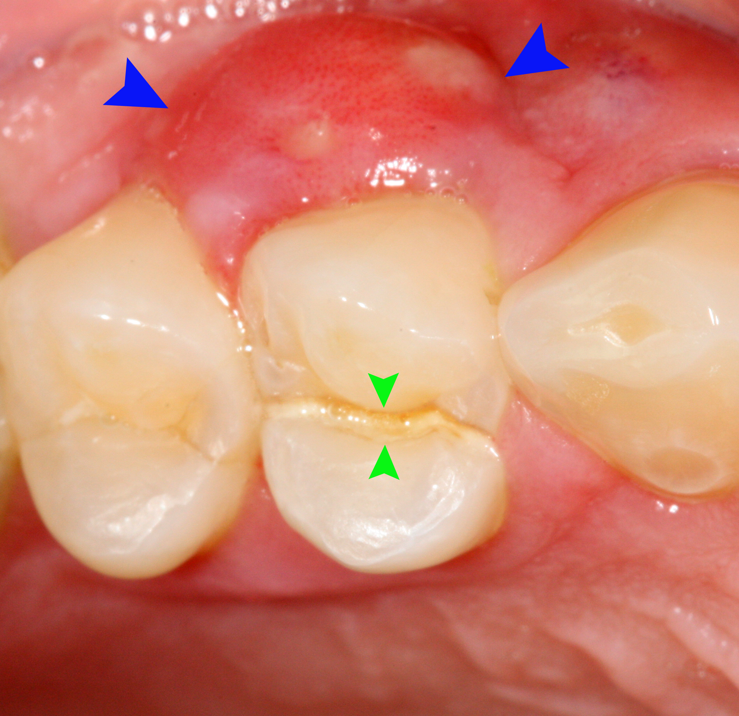 Vertical fracture of upper first premolar (green arrows) has caused a periodontal abscess (blue arrows).