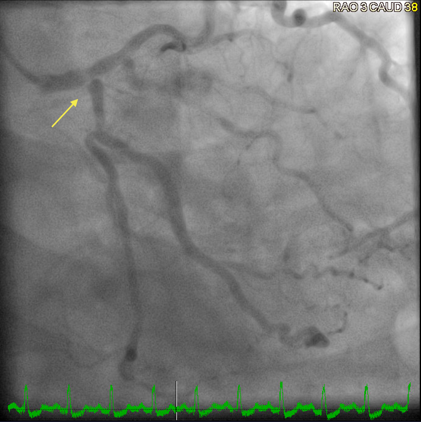 Coronary angiogram showing severe left main coronary artery disease with a bifurcation lesion involving the ostial left anterior descending artery and the ostial left circumflex artery