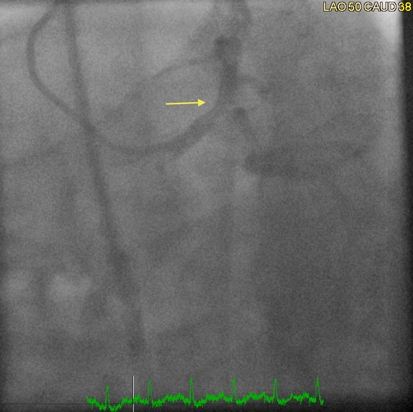 Coronary angiogram in a patient with radiation-induced coronary artery disease showing severe obstructive left main disease with bifurcation lesion affecting the Ostia of the left anterior descending artery and the left circumflex artery