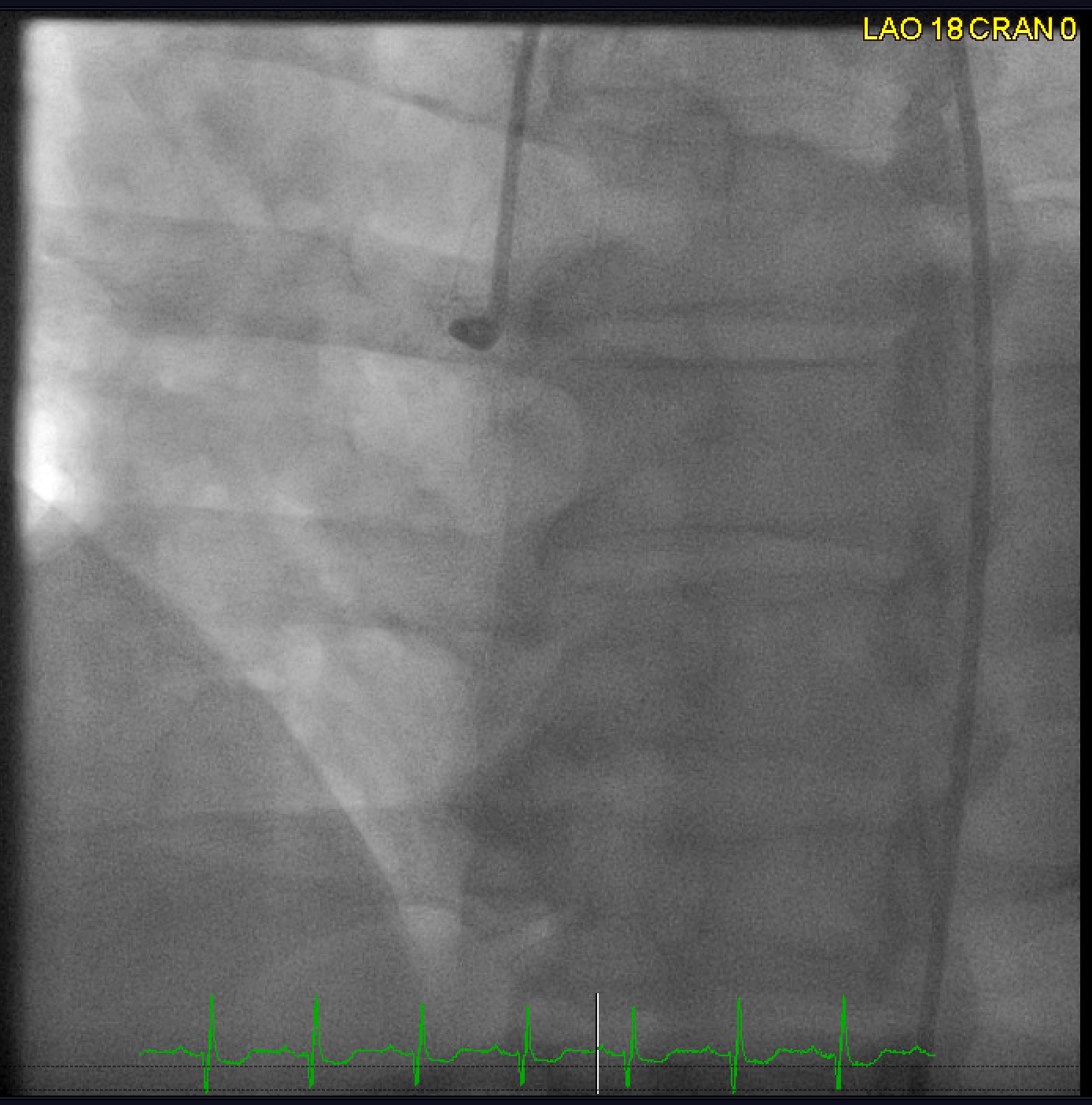 Coronary angiogram in a patient with radiation-induced coronary artery disease with blunt stump chronic total occlusion of the right coronary artery
