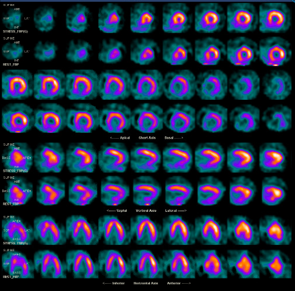 Single photon emission computed tomography (SPECT) myocardial perfusion imaging with adenosine showing fixed perfusion defect of the entire inferior wall in a patient with known mediastinal radiation exposure 15 years ago for Hodgkin's lymphoma