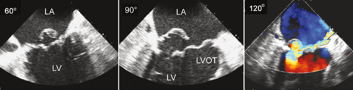<p>Posterior Mitral Leaflet With Flail Central Scallop (P2) Flail