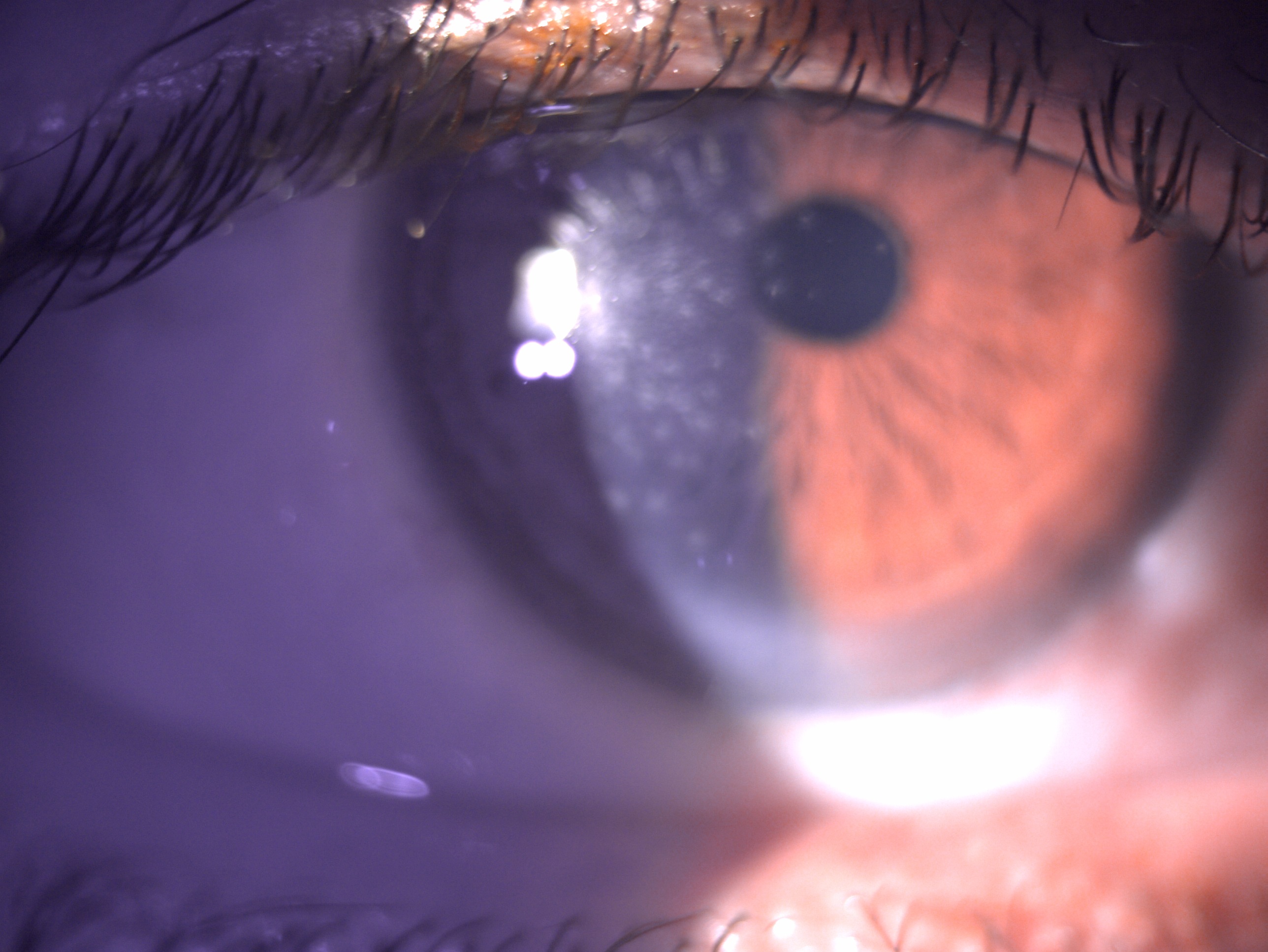 Digital image depicting multiple subepithelial scars post viral keratitis causing astigmatism