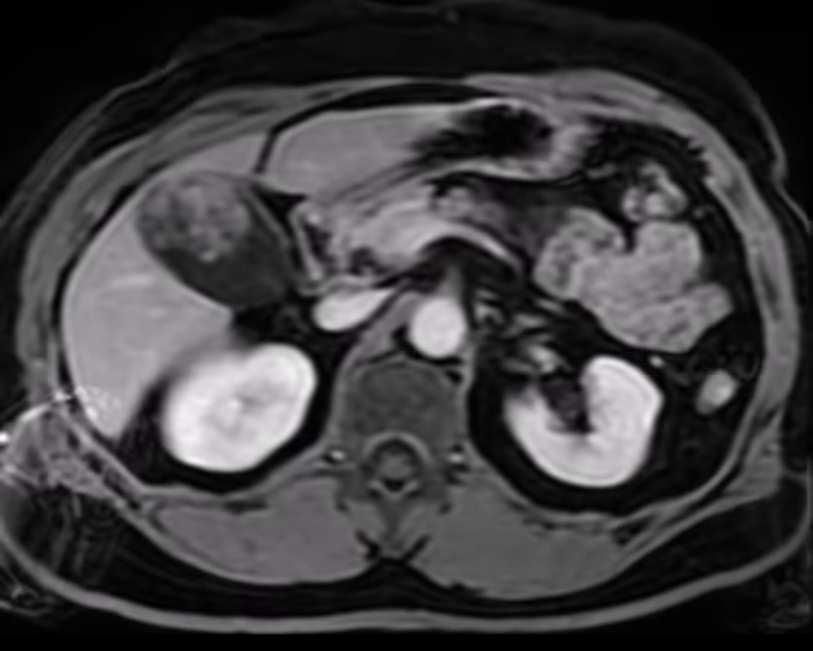 <p>Gallbladder Carcinoma. Computed tomography image demonstrating a gallbladder neoplasm.</p>