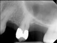 Periapical radiolucency