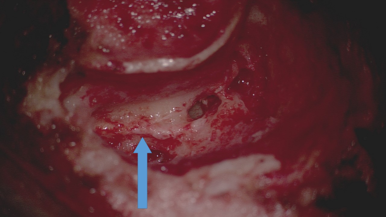 Transmastoid facial nerve decompression. The facial nerve is indicated by the blue arrow.