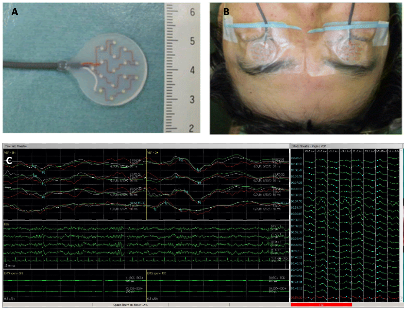 Flash stimulation pads used for surgical intraoperative monitoring. Intraoperative visual evoked potentials (VEPs) results.