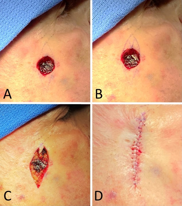 M-plasty used for closure of basal cell carcinoma resection defect inferolateral to eye
