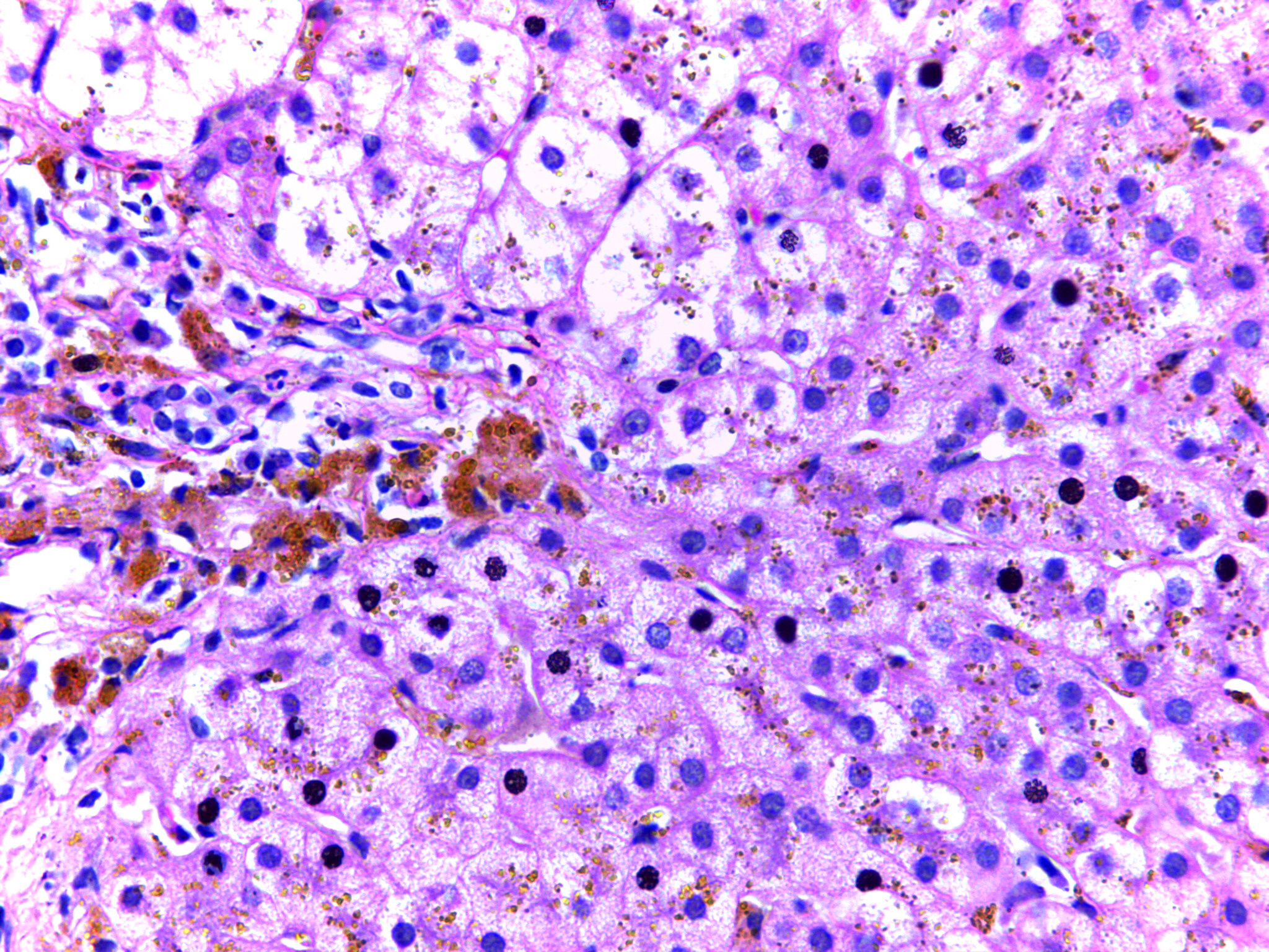 Image 1: Micrograph of hemochromatosis liver showing hepatocytes with coarse golden yellow granules of hemosiderin within the cytoplasm