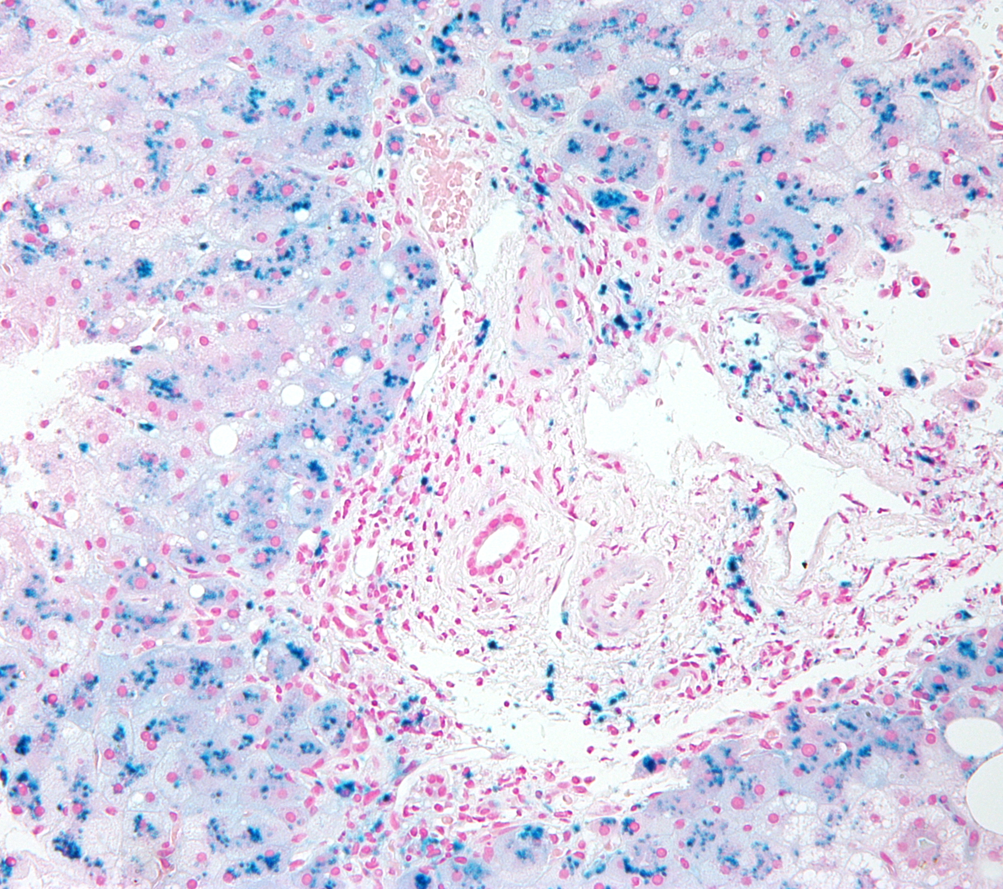 High magnification micrograph of hemosiderosis. Liver biopsy. Iron stain (Prussian blue).