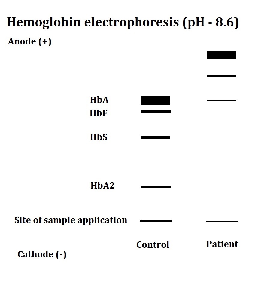 <p>&alpha;-Thalassemia Major on Hemoglobin Electrophoresis