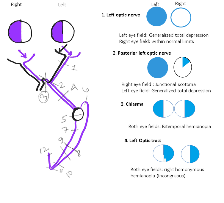 <p>Neuroophthalmic Visual Field Defects (Schematic Drawing 1)