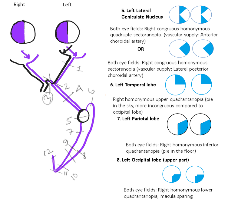 <p>Neuroophthalmic Visual Field Defects (Schematic Drawing 2)