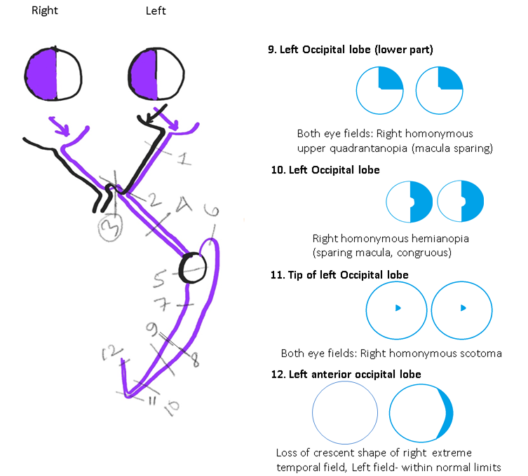 <p>Neuroophthalmic Visual Field Defects (Schematic Drawing 3)