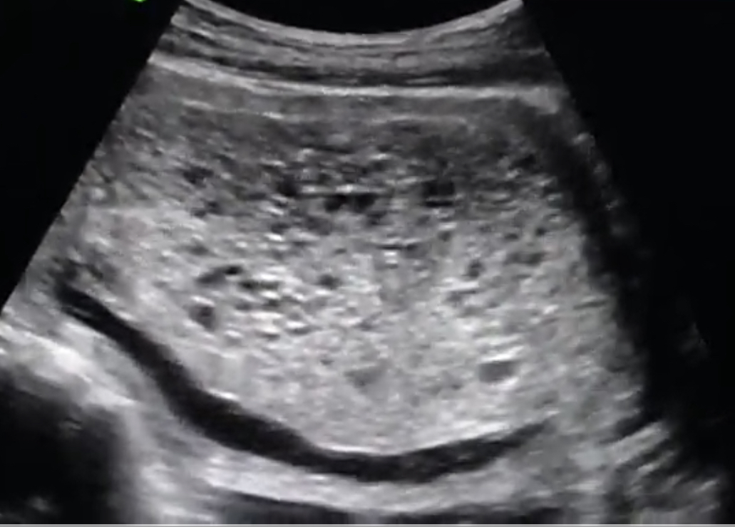 Sonography of Complete Molar Pregnancy-Snow storm appearance