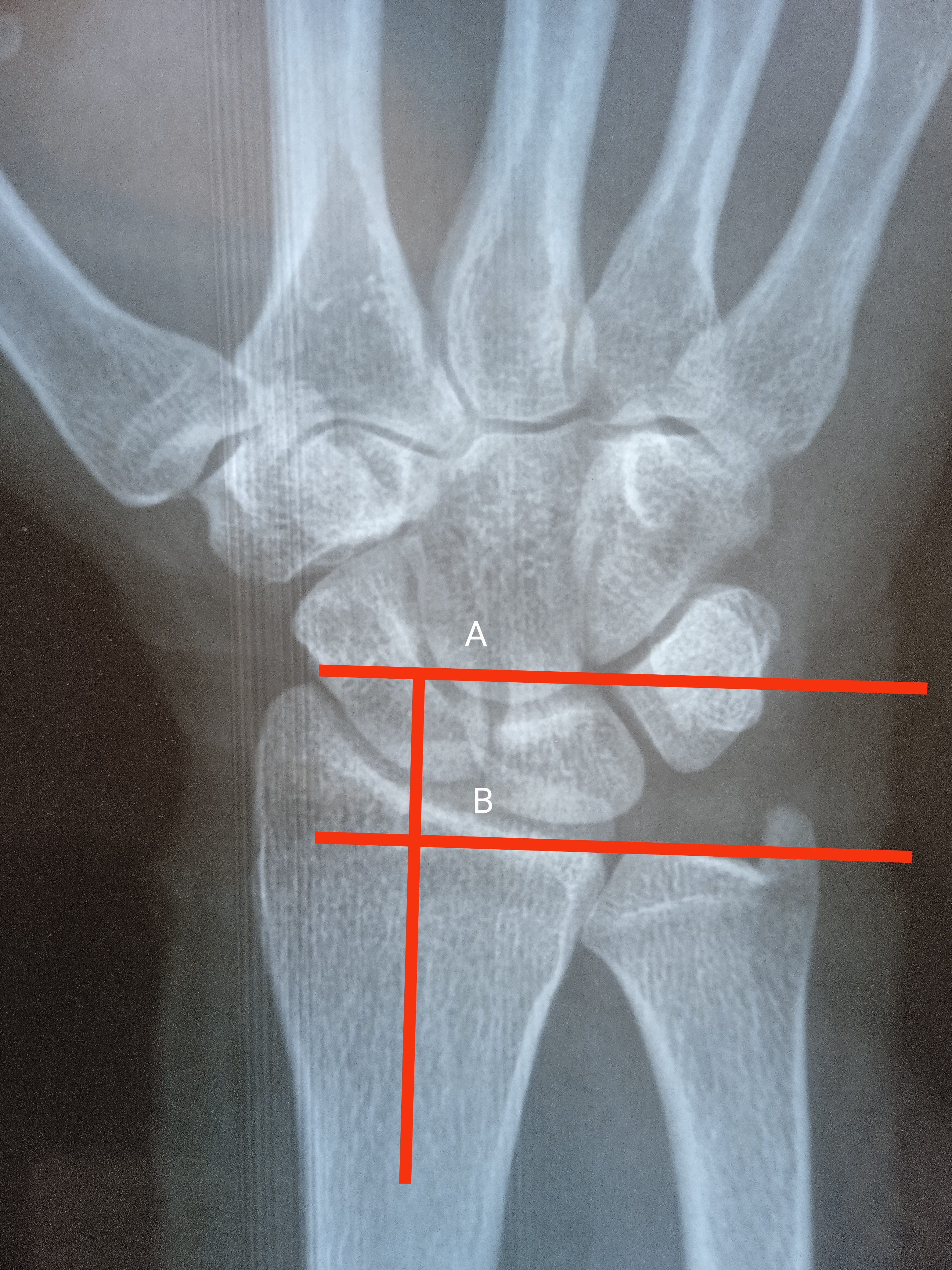 Colles Fractures  Central Coast Orthopedic Medical Group