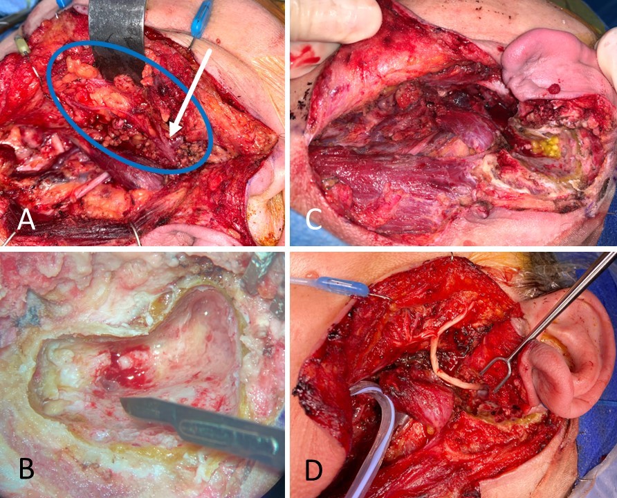 A 59-year-old female with carcinoma ex pleomorphic adenoma underwent total parotidectomy with facial nerve sacrifice from halfway down the mastoid segment to the distal branches, past the pes anserinus