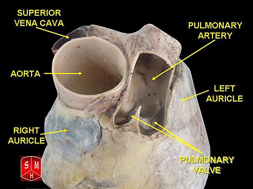<p>Cadaveric dissection of human heart showing left atrial appendage (left auricle)</p>