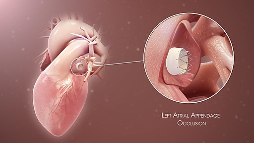 <p>Illustration of left atrial appendage occlusion device used for stroke prevention in patients with atrial fibrillation</p>