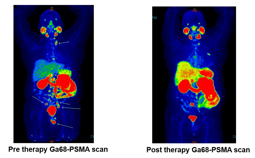 A pre and post Lu-177-PSMA therapy 68-Ga-PSMA PET-CT scan showing positive otcomes