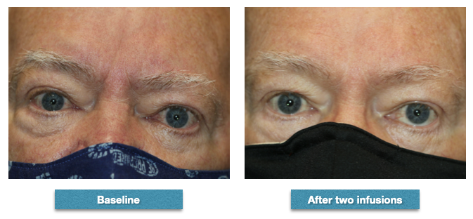 At baseline prior to infusions, the patient had proptosis of 24 mm right eye and 25 mm left eye