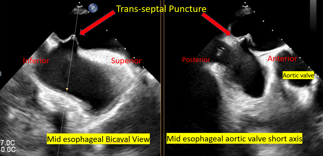 <p>Transseptal Puncture for MitraClip Procedure