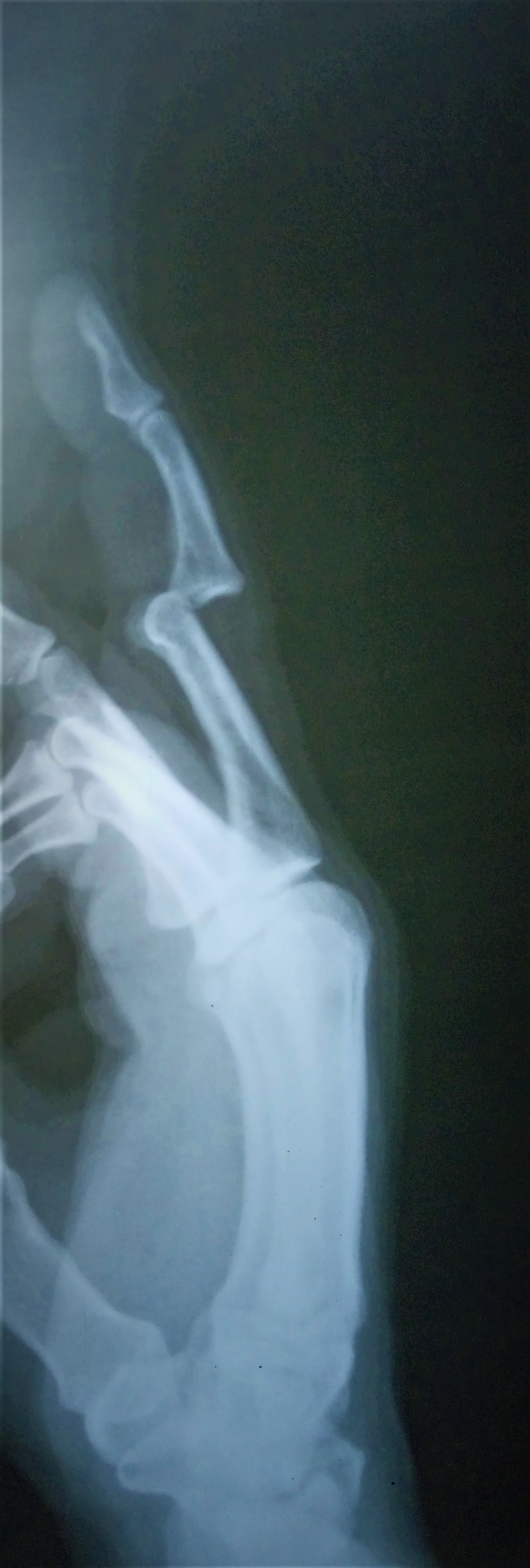 <p>Proximal Interphalangeal Joint Dorsal Dislocation</p>