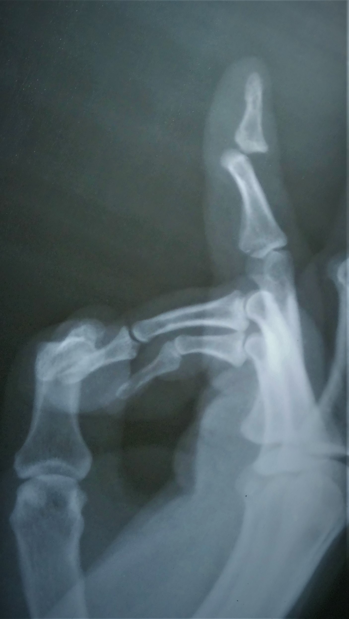 <p>Distal Interphalangeal Joint Dorsal Dislocation</p>